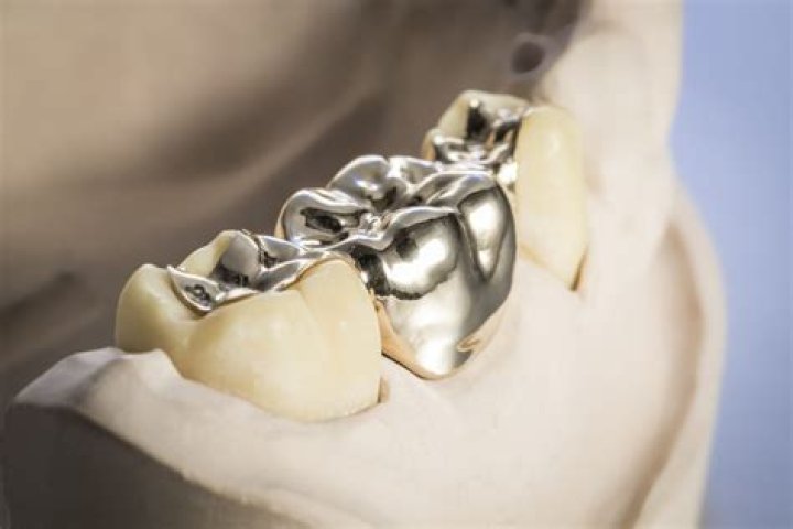 Are gold dental crowns toxic?