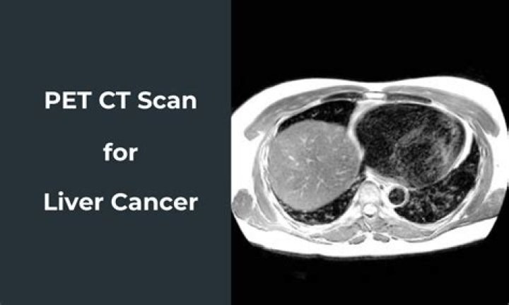 Can a CT scan detect liver damage?