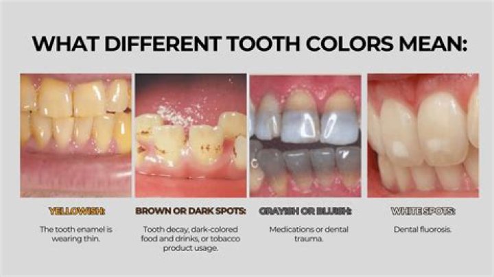 Can brown teeth become white again?