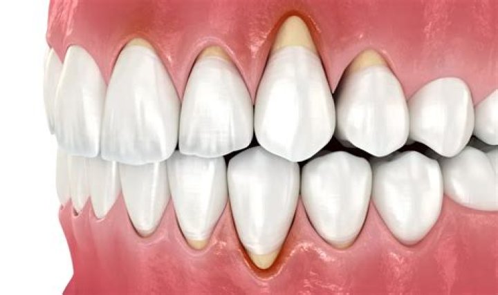 Can gingivitis be cured permanently?