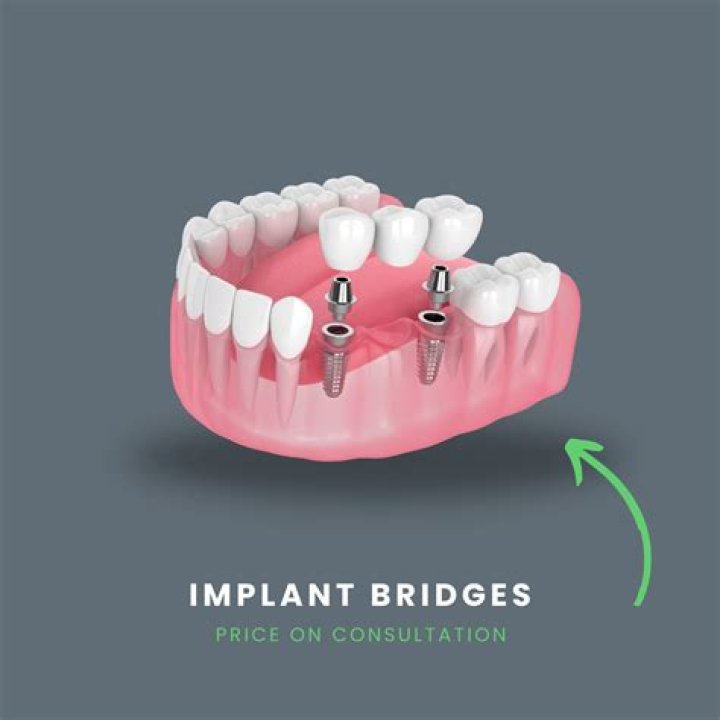Can I get a bridge instead of an implant?