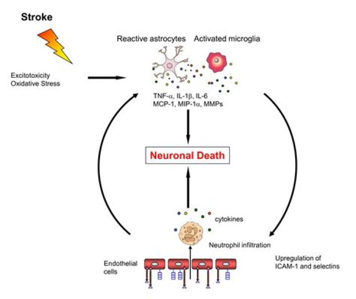 Can stress cause ischemic stroke?