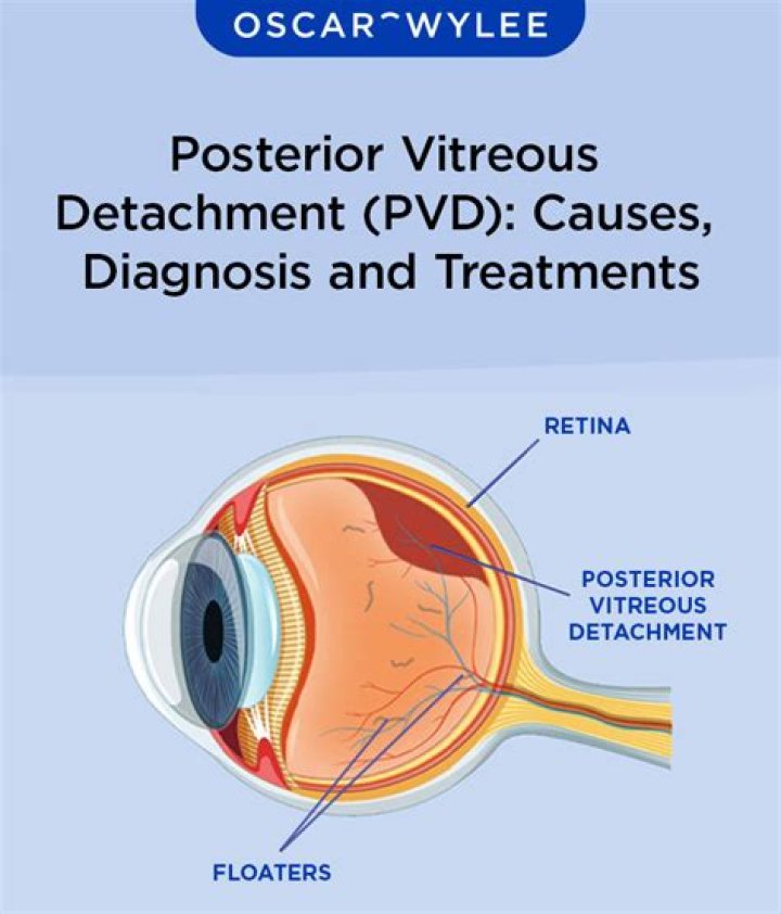 Can stress cause posterior vitreous detachment?