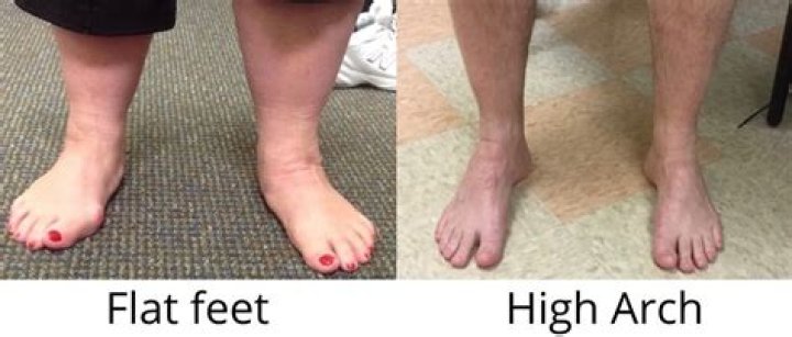 Can you be drafted if you have flat feet?