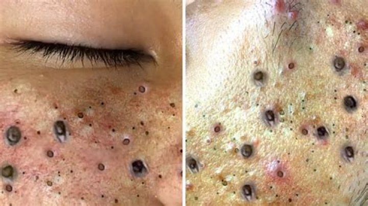 Can you close blackhead holes?