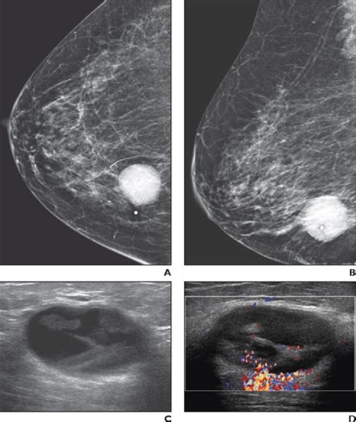 Do cancerous cysts hurt?