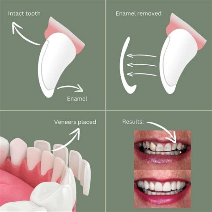 Do they cut gums for veneers?