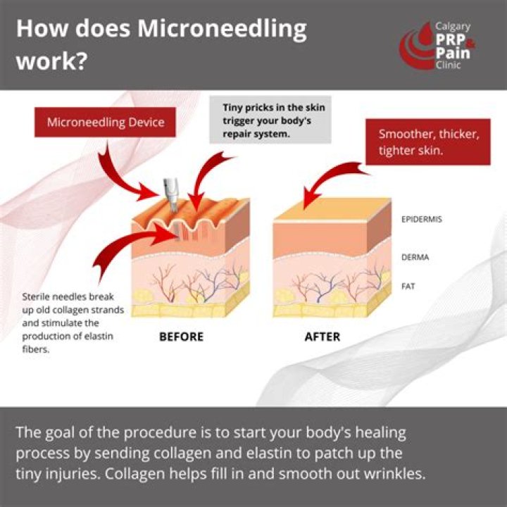 Does microneedling work on jawline?