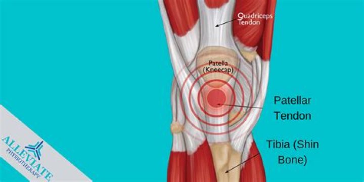Does tendonitis ever go away?