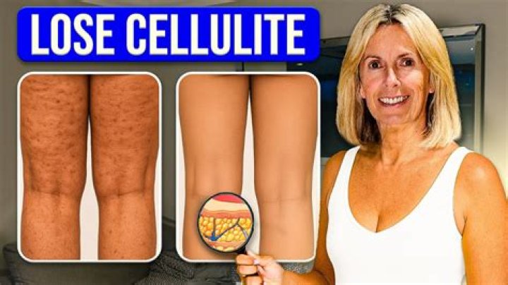 Does walking remove cellulite?