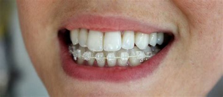 How do you smile with braces?