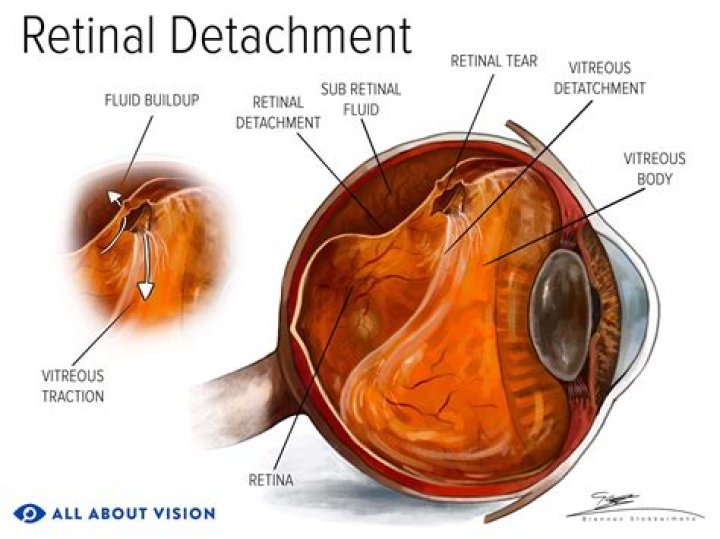 How do you treat vitreous detachment naturally?