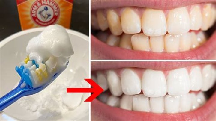 How fast does baking soda whiten teeth?