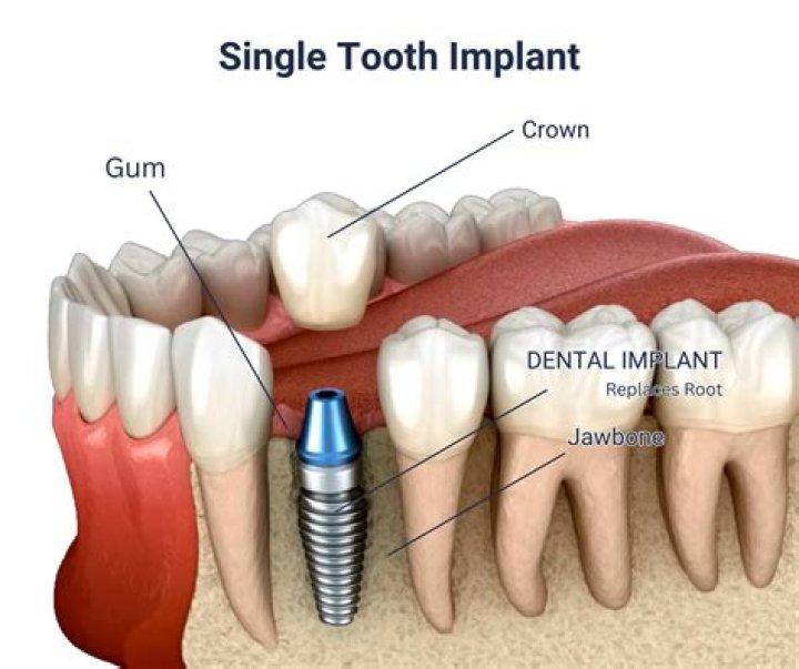 How long do single tooth implants last?