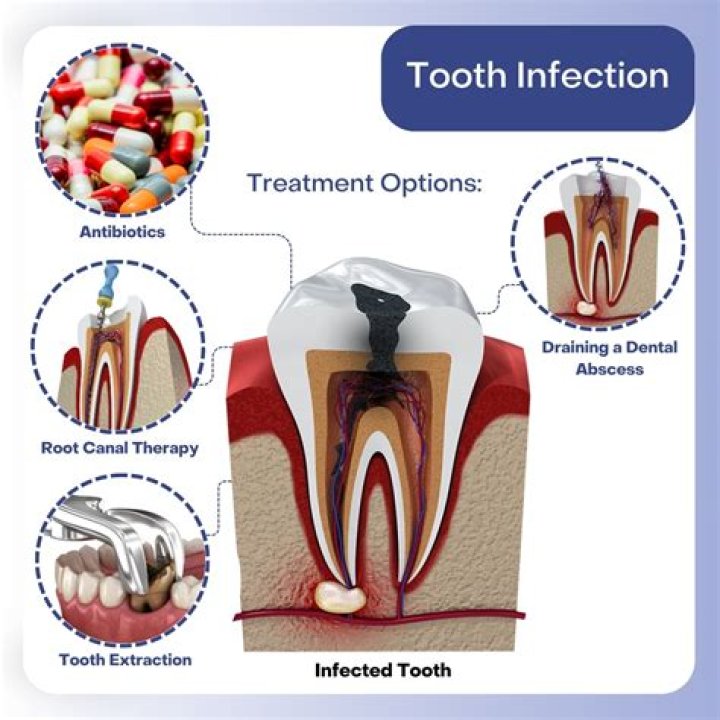 How long does an infected tooth last?