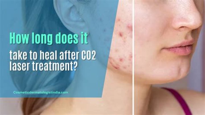 How long does CO2 laser pain last?