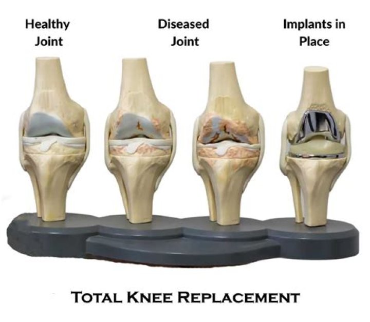 How many people are happy with their knee replacement?