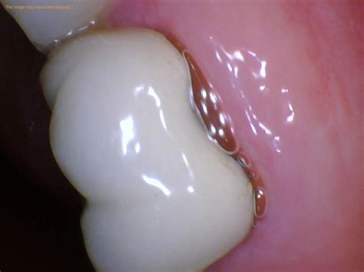 How many times can a crown be replaced?