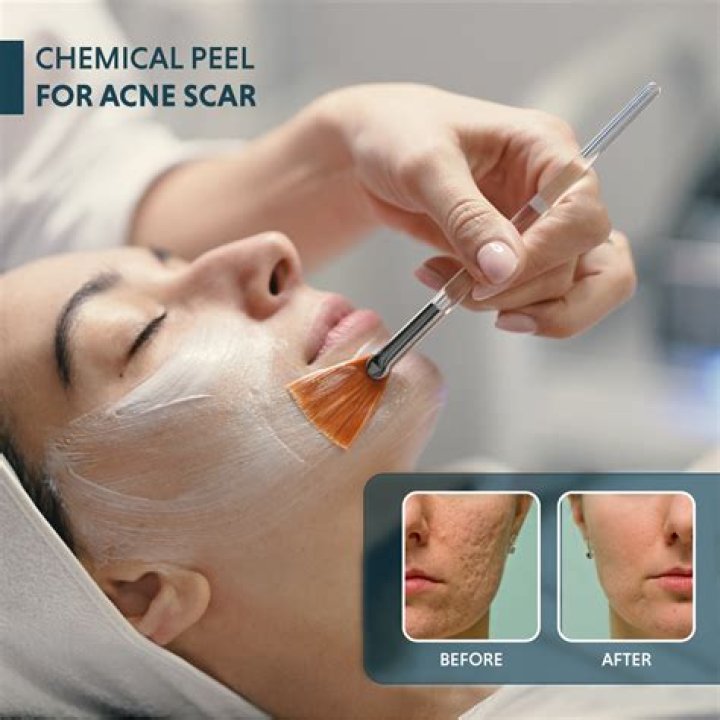 How many times can we do chemical peel?