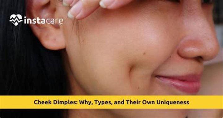 How rare are knuckle dimples?