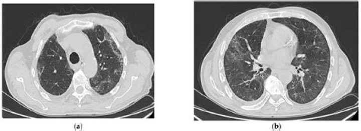 Is pulmonary fibrosis (lung scarring) associated with COVID-19 infection?