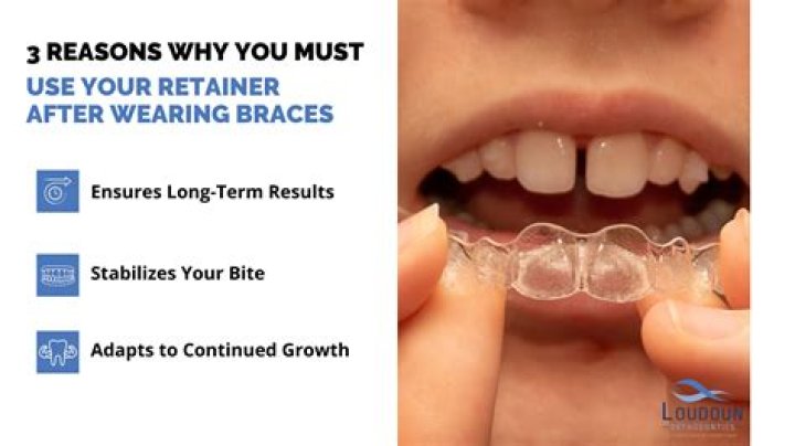 What's the longest you can go without wearing retainers?