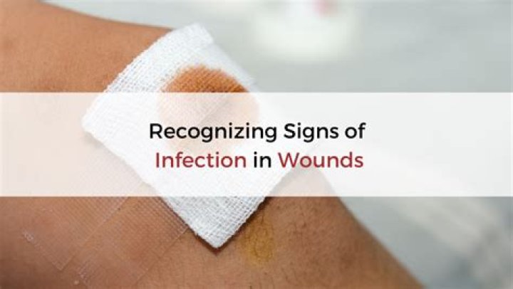What are the 5 signs of infected wound?
