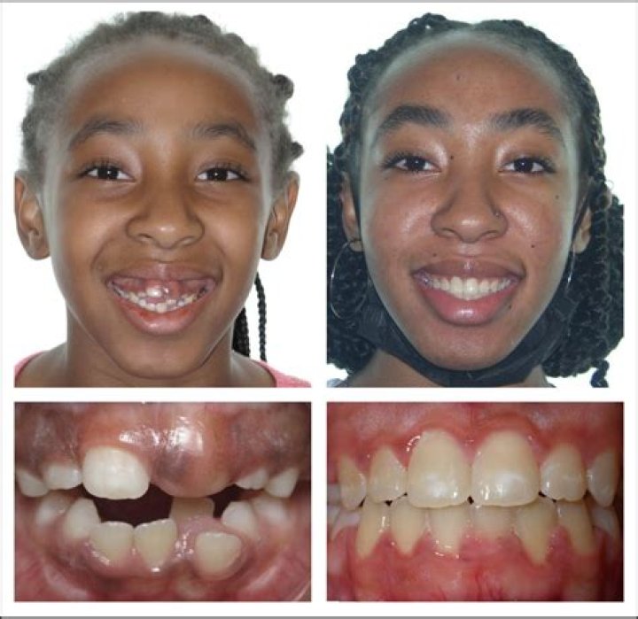 What are the three stages of braces?