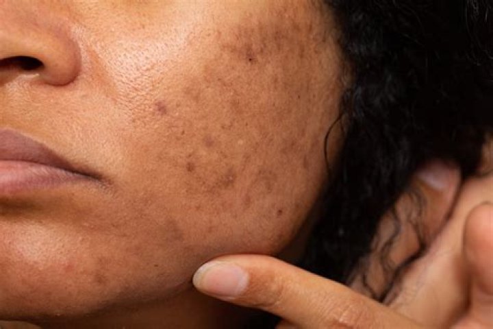 What do doctors prescribe for dark spots?