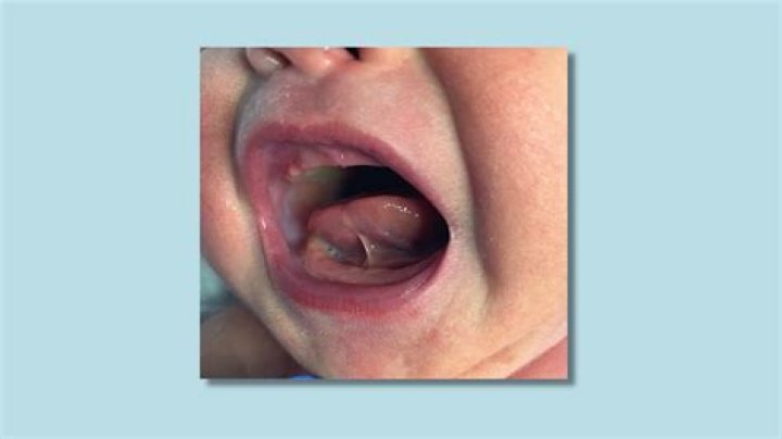 What does a normal tongue-tie look like?