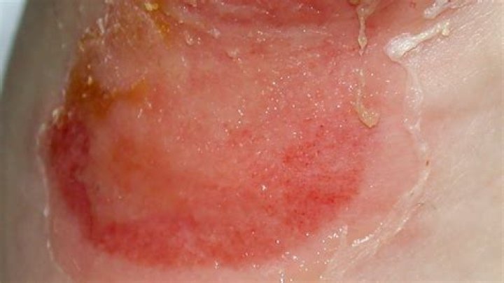 What does a yeast infection on the skin look like?