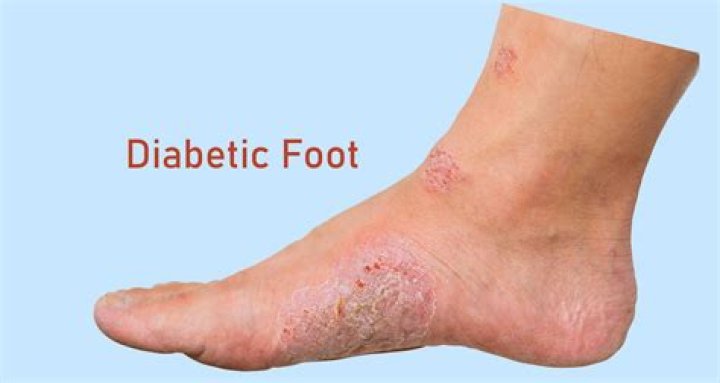 What does diabetic legs look like?