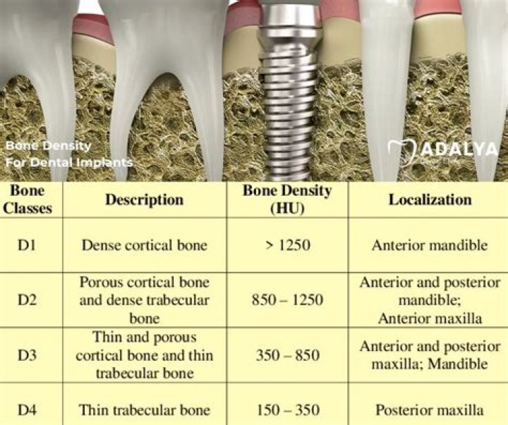 What happens if you don't have enough bone for dental implants?