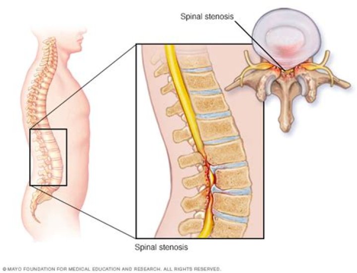 What happens if you let spinal stenosis go untreated?