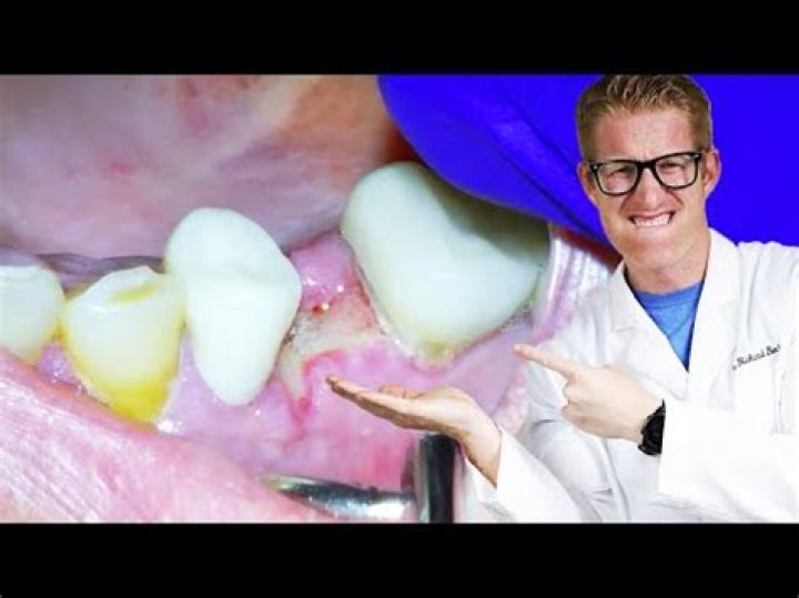 What happens with tooth extraction?