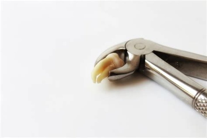 What is the white stuff after tooth extraction?