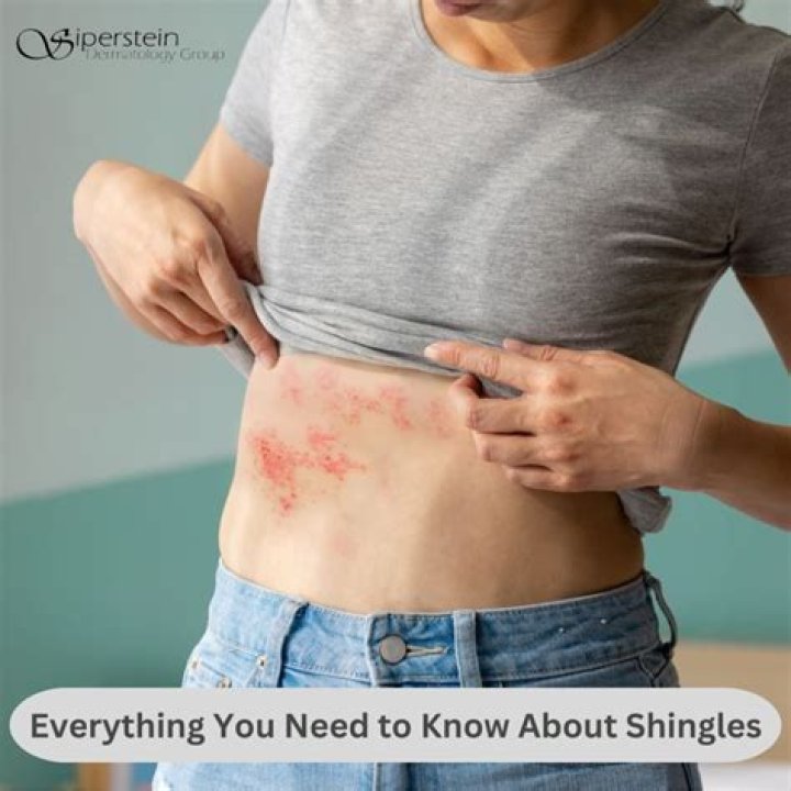 What triggers a shingles outbreak?