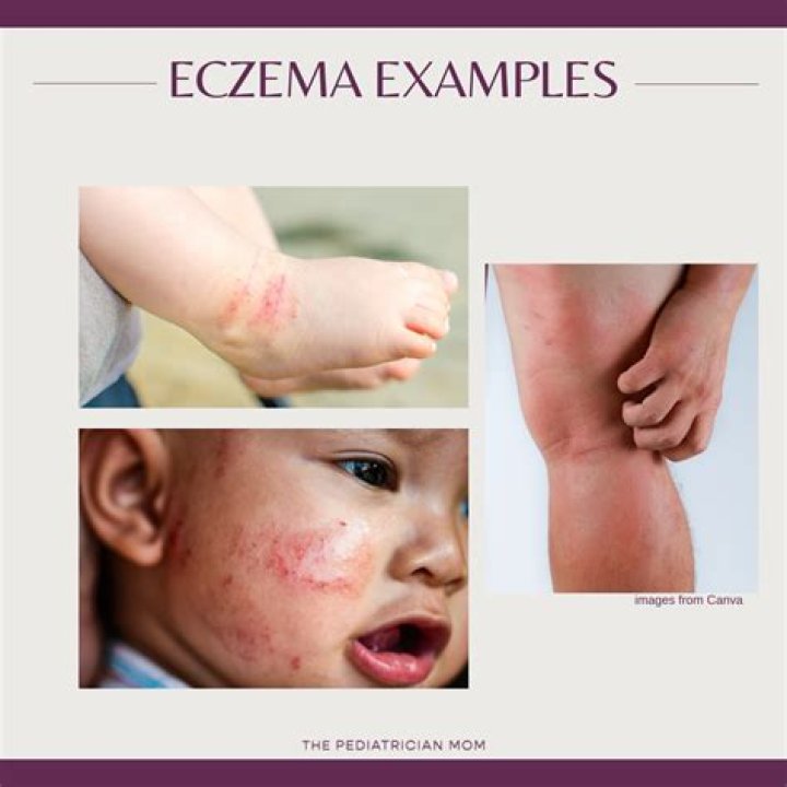 What vitamins help eczema?