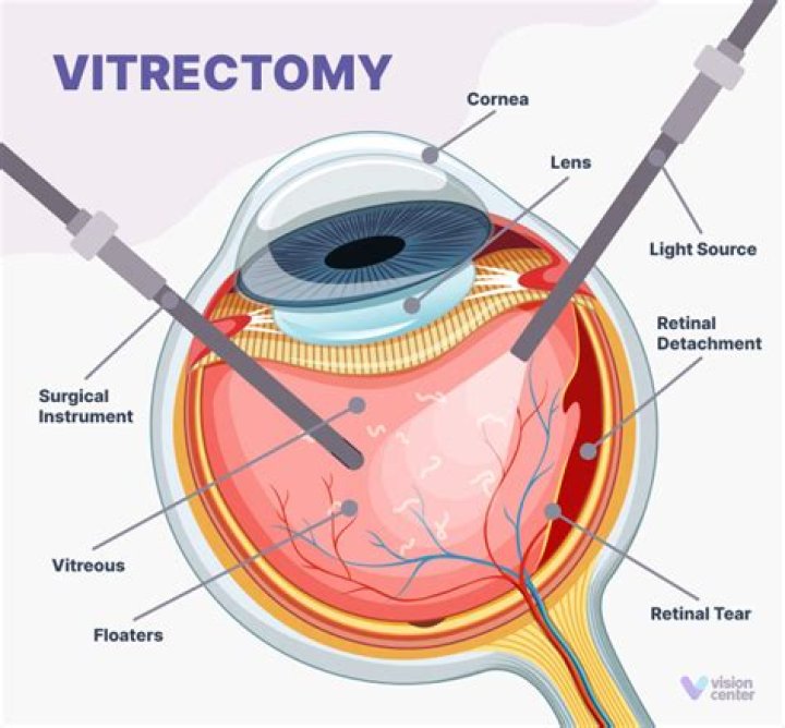 When does vision improve after vitrectomy?