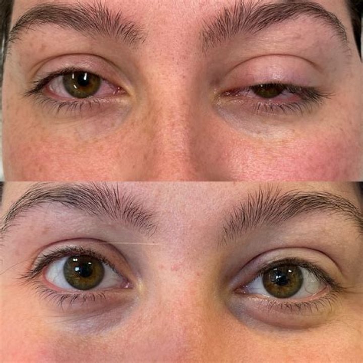 Why are my eyelids drooping?
