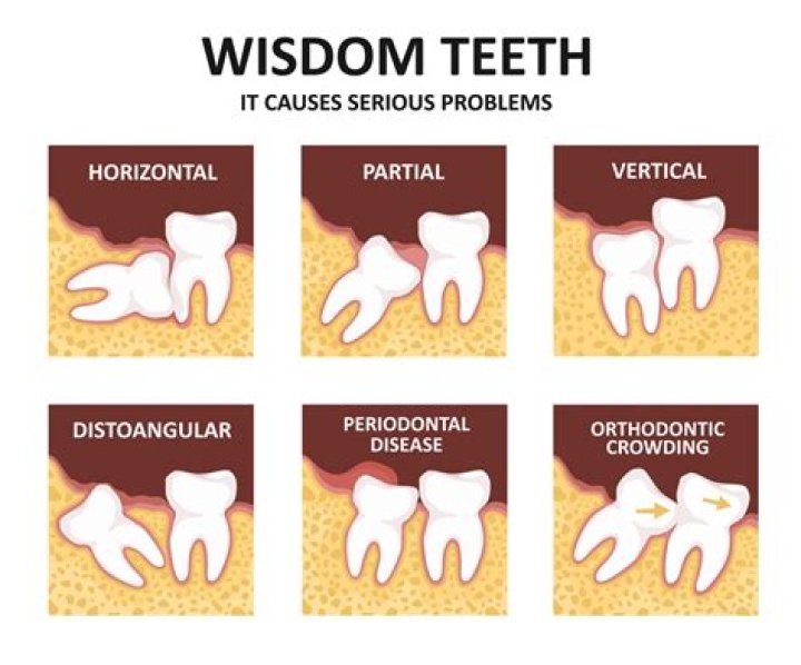 Why do dentists always want to pull wisdom teeth?