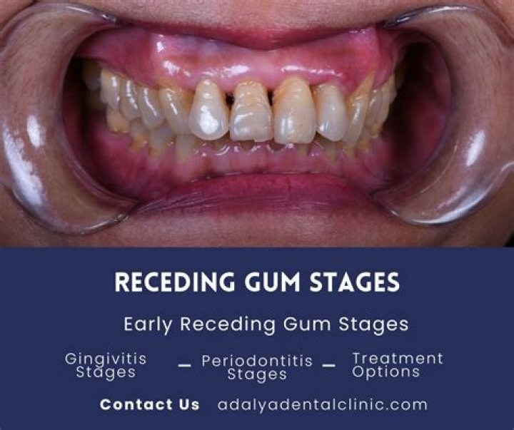Why do gums recede as we age?