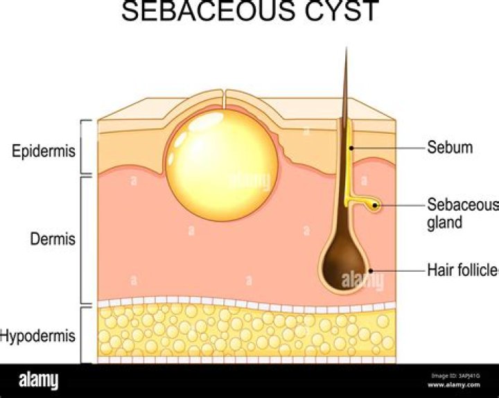 Why do I get a lot of sebaceous cysts?