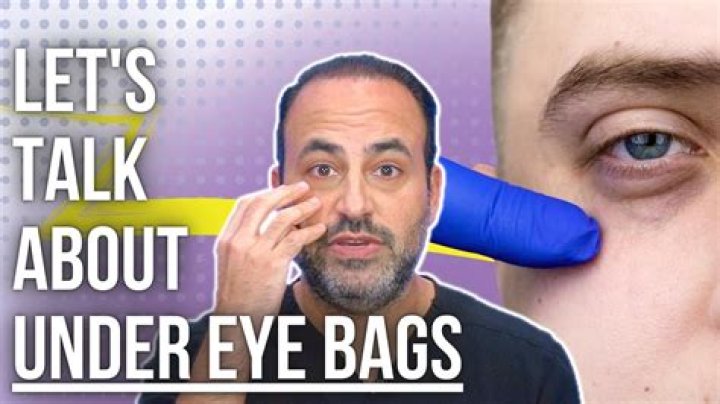 Why do I have eye bags at 15?