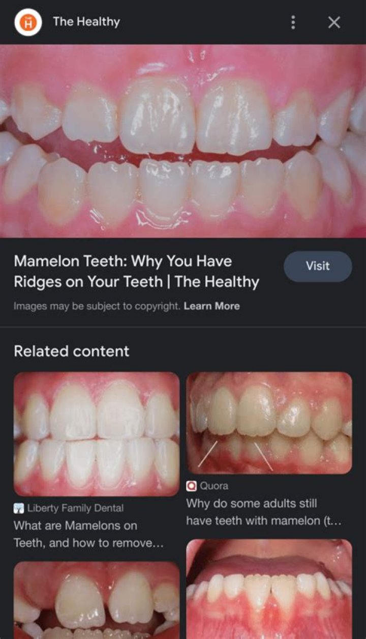 Why do some people's teeth have ridges?