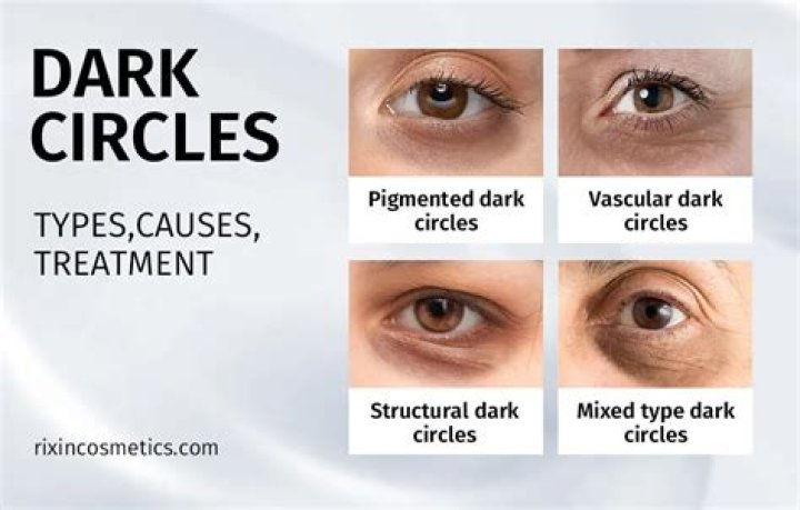 Why do South Asians get dark circles?